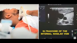 Ultrasound of the Internal Jugular Vein