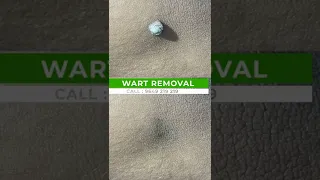 Best Things About Wart Removal Treatment | Viral #shorts