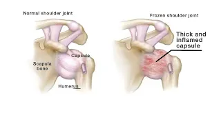 Mayo Clinic Minute: Tips to help a frozen shoulder