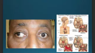 Aneurisma Cerebral No Roto. ¿Cuándo es urgente?- Dr. Carlos Mario Jiménez