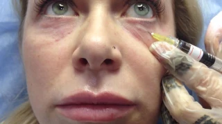 АирисКом студенты учатся: Филлеры. Заполнение морщин гиалуроновой кислотой область вокруг глаз.