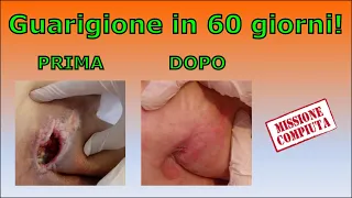 SOLUZIONE EFFICACE per piaghe da decubito (lesioni/ulcere/piaghe da pressione, ulcere da decubito)