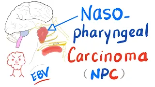 Nasopharyngeal Carcinoma (NPC): Location, Risk Factors, Clinical Picture, Diagnosis& Management