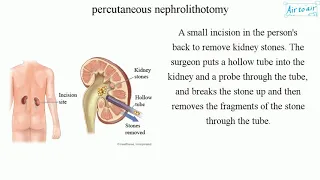 percutaneous nephrolithotomy