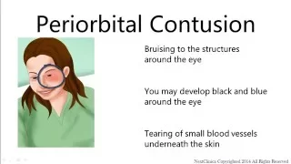 Periorbital contusion with CT