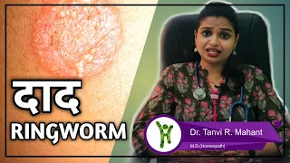 Ringworm (Tinea Corporis) | Causes, Risk Factors, Signs & Symptoms, Diagnosis and Treatment