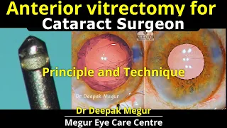 Anterior Vitrectomy Technique for Cataract Surgeons. The Answers all surgeons should know: Dr Megur