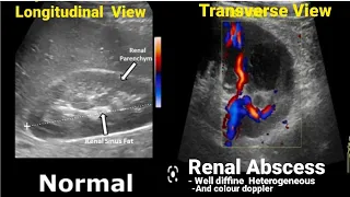 Kidney Ultrasound Normal vs Abnormal Appearances Comparison