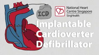 What is an Implantable Cardioverter-Defibrillator (ICD) | What to Expect