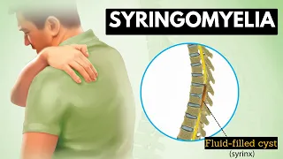 Syringomyelia: Everything You Need To Know