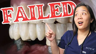 Watch This Before It’s Too Late: Why Dental Implants Fail