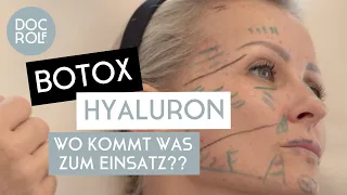 BOTOX oder HYALURON – wann verwendet man was?! Dr. Rolf Bartsch