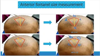 General Physical Examination in Children | Head to Toe assessment I Pediatrics