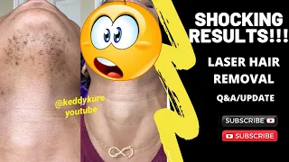 Shocking Results! Before & After Laser Hair Removal Treatment Under Chin!