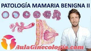PATOLOGÍA BENIGNA DE LA MAMA II: FIBROADENOMA, PAPILOMA, HIPERPLASIA...  - Ginecología y obstetricia