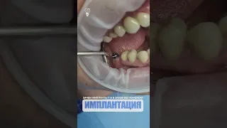 Зачем импланты 7 и 8 зубов без коронок? implants of 7 and 8 teeth without crowns?