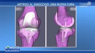 Artrosi al ginocchio: una nuova cura