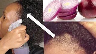 2ways to use ONION 🌰 JUICE For MASSIVE HAIR GROWTH|Jalia Walda