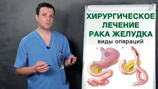 Рак желудка - хирургическое лечение рака желудка. Врач-онколог Владимир Лядов.