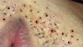 Treatment Of Blackheads And Hidden Acne #063