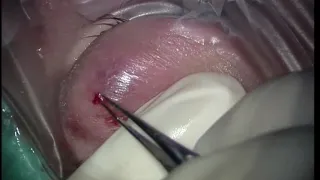 Eyelid Abscess Drainage