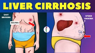 Liver cirrhosis - Warning Signs 🔥 Don't ignore these Red Flags | Chronic Liver Disease | Fatty Liver