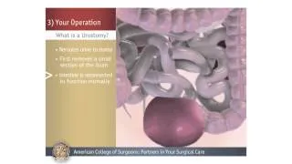 Urostomy: Your Operation