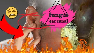 fungus ear canal causes pain
