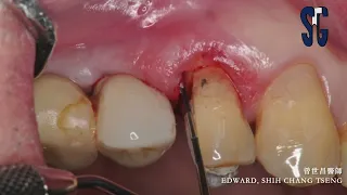 Restorative crown lengthening via tunneling