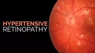 Hypertensive Retinopathy | Stages | Keith-Wagener-Barker classification