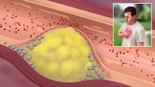 Atherosclerosis Pathophysiology, USMLE