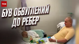 😱 Боялись, що "розсиплеться"! Медики врятували бійця з опіками, для яких немає кваліфікації