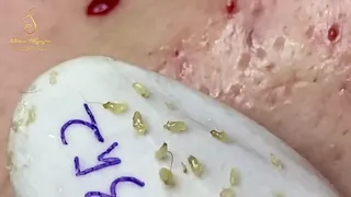 A lot of blackheads on the female client's face (352a) | Loan Nguyen