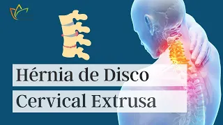Hérnia de Disco Cervical Extrusa!