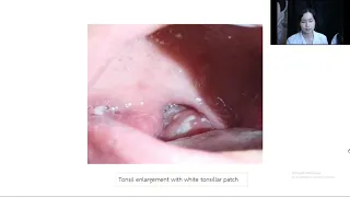 Mini lecture 12 Infectious mononucleosis Clinical presentation & treatment