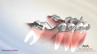 Orthodontic Treatment for Molar Uprighting - Cantilever Spring