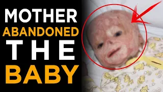 A mother abandoned her own burned baby in the hospital