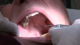 Dental coverage expanded for New Yorkers with Medicaid