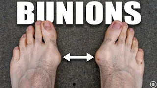 Bunions | Hallux Valgus (Diagnosis, Exercises, Treatment)