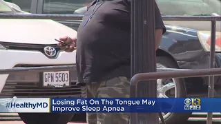 Healthwatch: Losing Fat On Your Tongue Could Help With Sleep Apnea