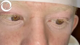 Oculocutaneous Albinism (Urdu/Hindi)