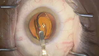 Deconstructing cataract surgery 4 - IOL implantation