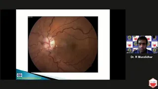 Dr Muralidhar - Optic Disc edema - Evaluation and recognition of sinister signs (NEURO-OPTHALMOLOGY)