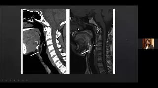 Radiological anatomy of Larynx and Hypopharynx- Dr Kajari Bhattacharya