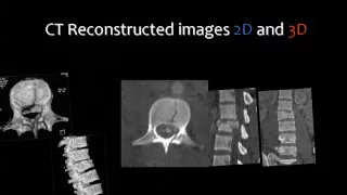 Imaging of Spinal trauma   Prof  Dr  Mamdouh Mahfouz 720p