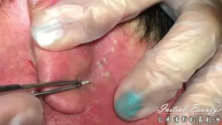 Perfect Time from Nhat Bang Spa  Extreme case of Ear Blackheads 2021 -  Difficult area removal