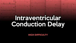 Intraventricular Conduction Delay ECG Quiz: High Difficulty