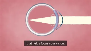 A Cutting-Edge Treatment for Cornea Damage (audio-described version)