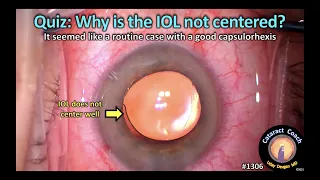 CataractCoach 1306: Cataract Quiz: why is the IOL not centered?