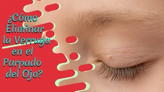 ¿Cómo eliminar la verruga en el parpado del ojo?
